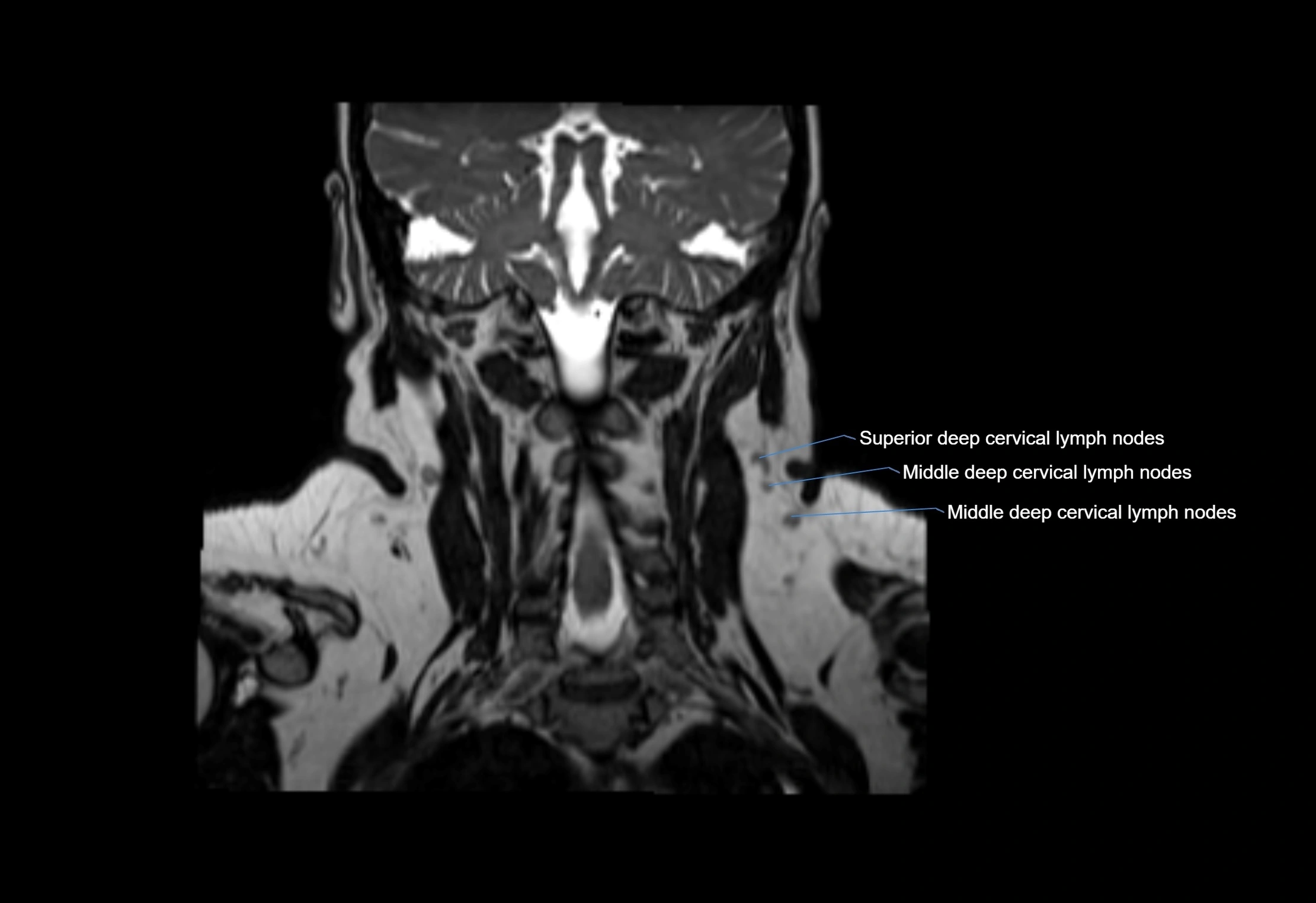 Neck coronal lymph node cross sectional MRI anatomy 3T MRI  image-img-00001-00021.webp